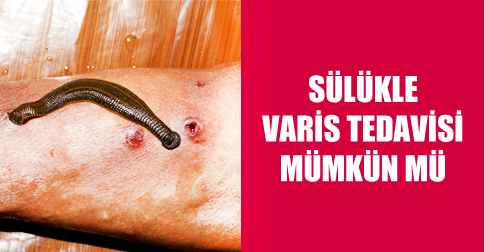 sulukle-varis-tedavisi