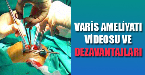 varis-ameliyati-video