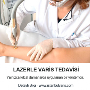 Lazerle Varis Tedavi