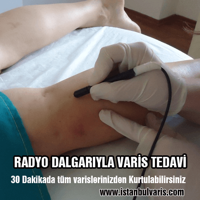 Radyo Dalgalarıyla Varis Tedavi